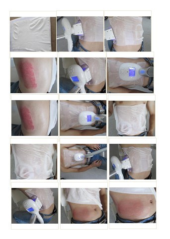 Non-Invasive Vacuum Coolsculpting Cryolipolysis Machine For Body Slimming